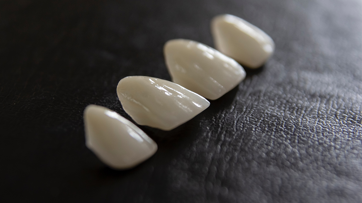 Lentes de Contato Dental para Fechar Espaçamentos: Uma Alternativa ao Aparelho Ortodôntico