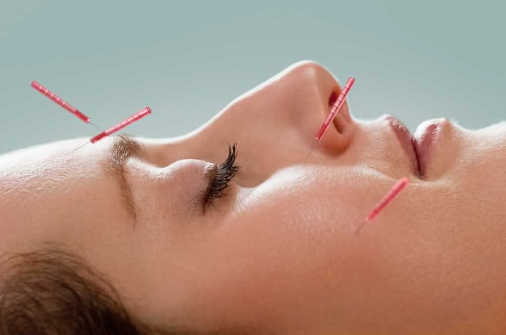 Tratamento com Acupuntura para Disfunção Temporomandibular (DTM)