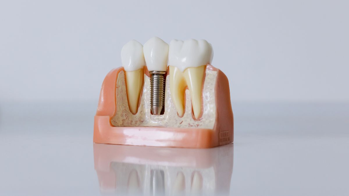 Experimente o futuro da odontologia: Implantes dentários indolores explicados