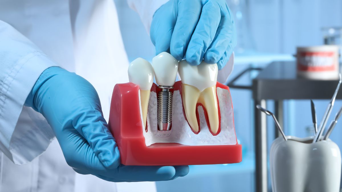 Revelando os segredos dos implantes dentários de zircônia: Seu caminho para um sorriso perfeitamente restaurado