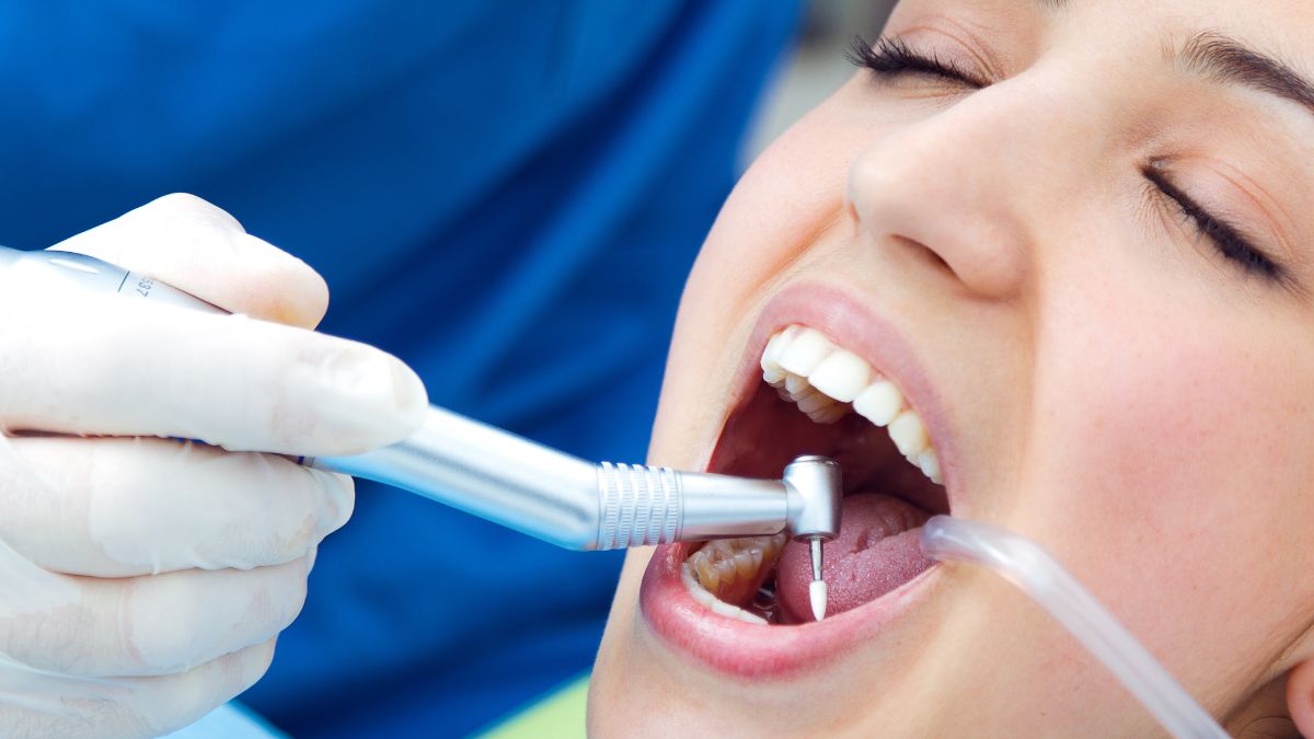 Lente de Contato Dental em Dente com Canal: É Possível?