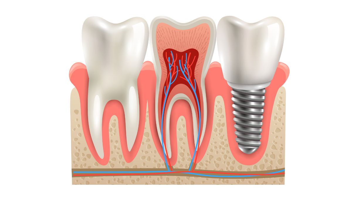Implante Dentário e Hipertensão: O que você precisa saber
