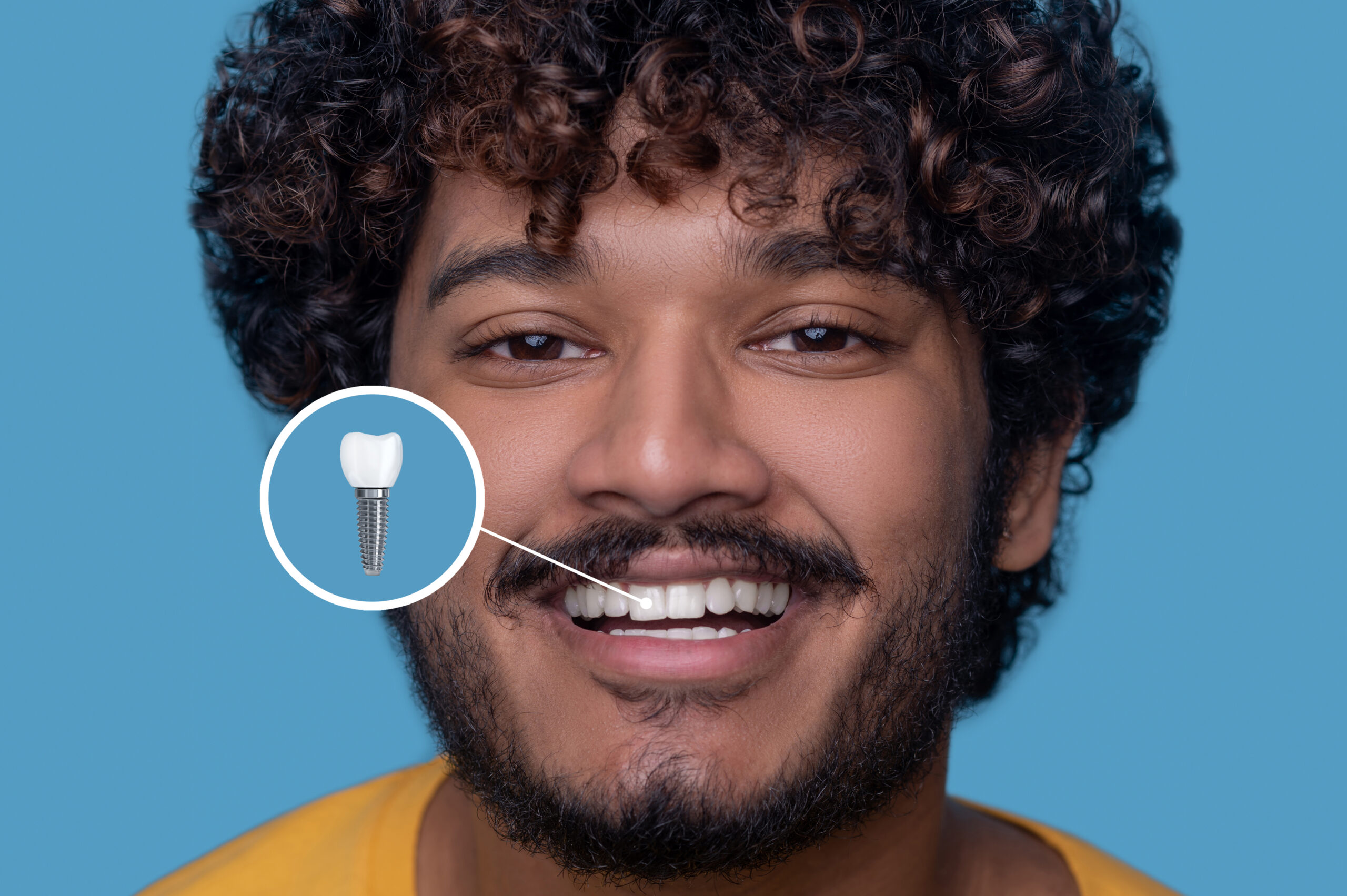 O Guia Definitivo para Cuidados com Implantes Dentários: Dicas e Melhores Práticas