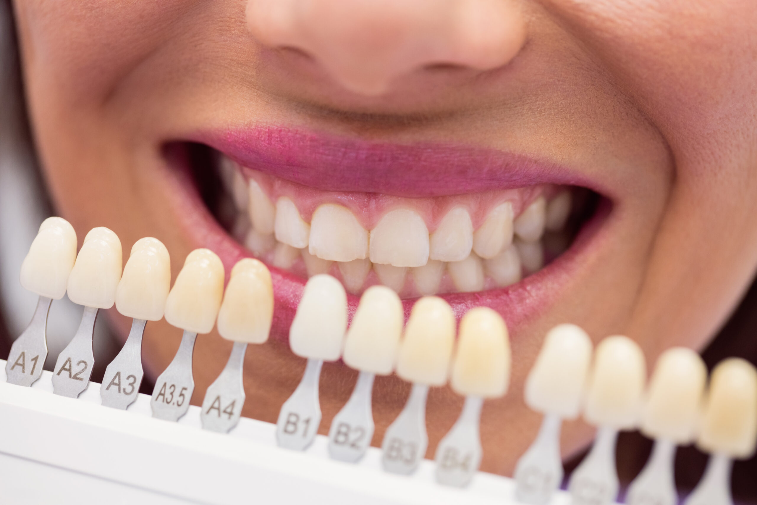 Como a Lente de Contato Dente Bruxismo pode transformar seu sorriso e aliviar o ranger dos dentes