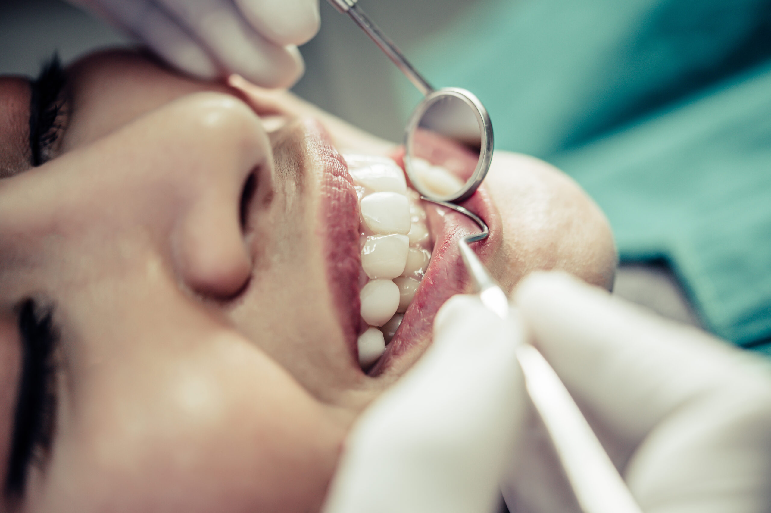 Desvendando o mistério: como a tecnologia das lentes de contato transforma os dentes